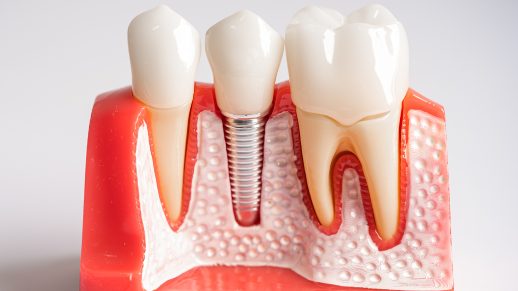 Dental implant pros vs. cons