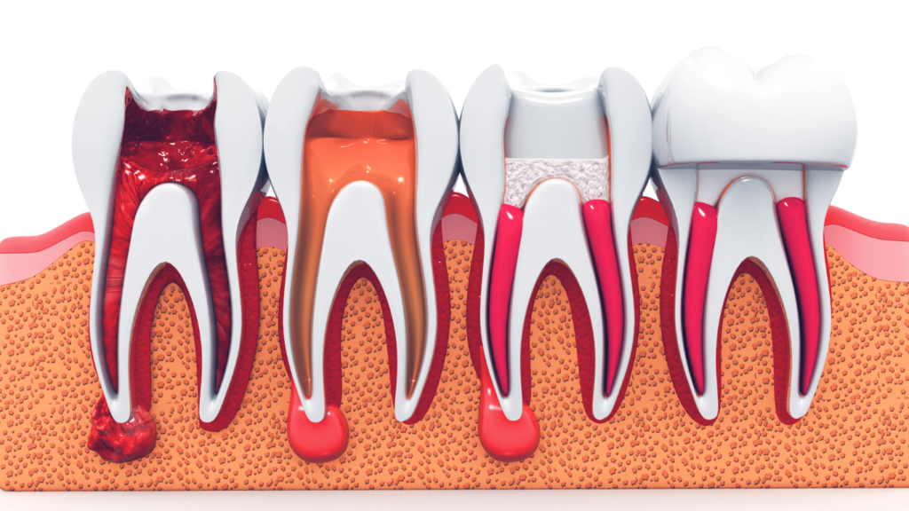 Root canal stages