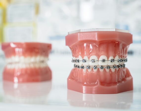 Braces removal St. Johns Florida