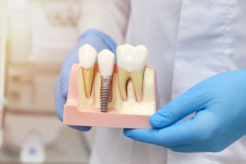 Guided dental implant