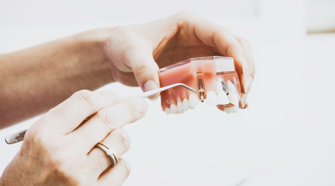 Dental implant longevity