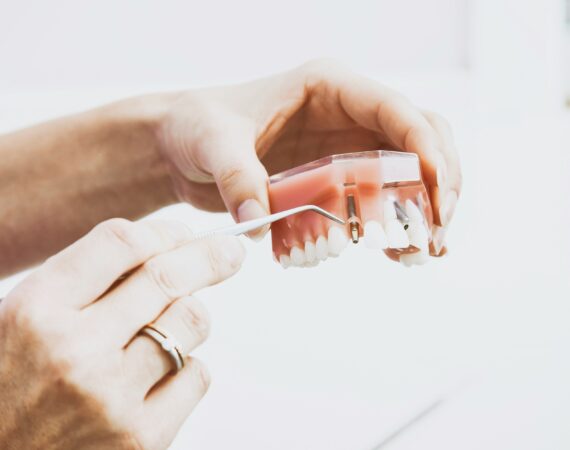 Dental implant longevity