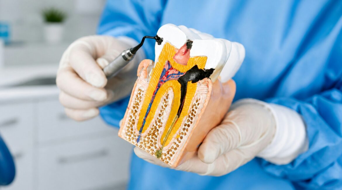 Root canal Jacksonville